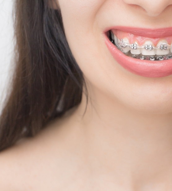 Corrige la posición de tus dientes con tratamientos modernos y personalizados. Logra una sonrisa armónica y funcional con especialistas en ortodoncia estética y tradicional...